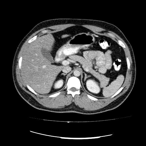 File:Appendicitis with diverticulosis (Radiopaedia 47693-52383 Axial C+ 38).jpg