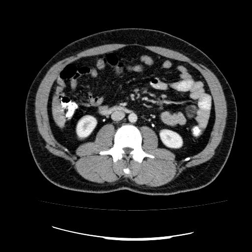File:Appendicitis with diverticulosis (Radiopaedia 47693-52383 Axial C+ 68).jpg