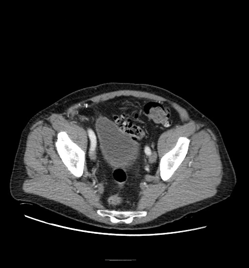 Appendicitis with localized perforation and abscess formation (Radiopaedia 49035-54130 A 74).jpg