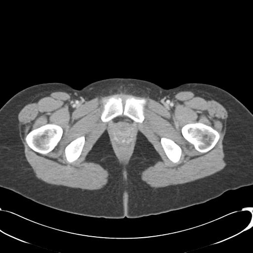 Appendicitis with minimal stranding but appendicolith (Radiopaedia 29035-29397 A 87).jpg