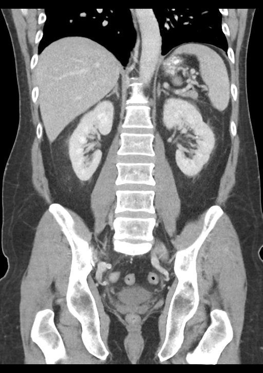 Appendicitis with thickening of the terminal ileum (Radiopaedia 42432-45550 B 38).png