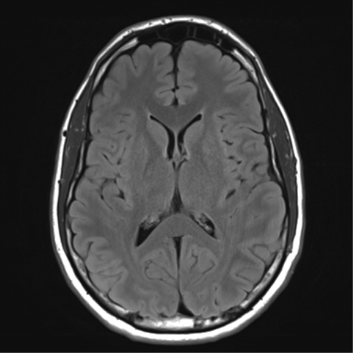 File:Arachnoid cyst - cerebellopontine angle (Radiopaedia 59689-67083 Axial FLAIR 21).png