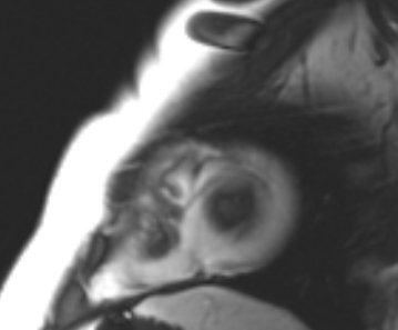 Arrhythmogenic right ventricular cardiomyopathy (Radiopaedia 69431-79307 Short axis cine 10).jpg