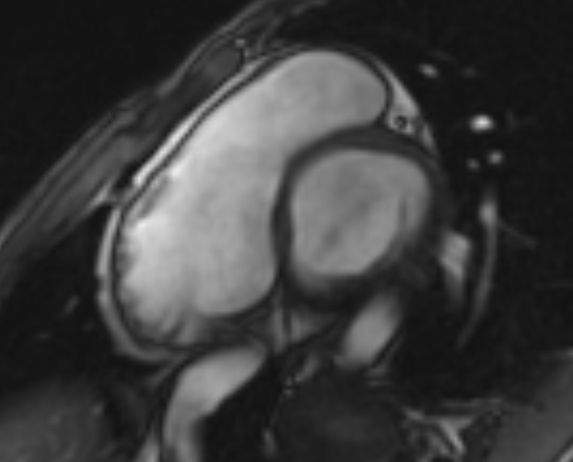 Arrhythmogenic right ventricular cardiomyopathy (Radiopaedia 69564-79464 short axis cine 238).jpg