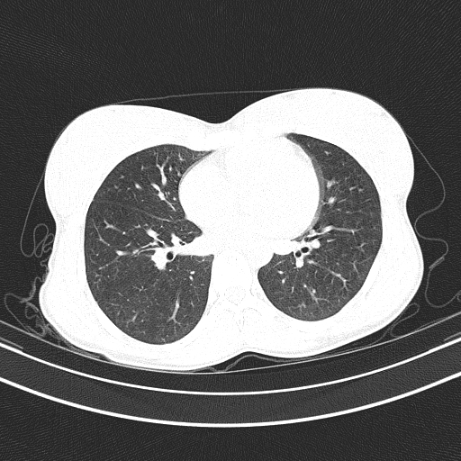 Arteria lusoria (Radiopaedia 88528-105192 Axial lung window 39).jpg