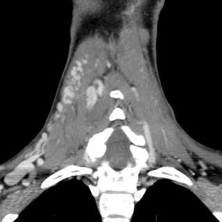 Arteriovenous malformation of the neck (Radiopaedia 53935-60062 D 34).jpg