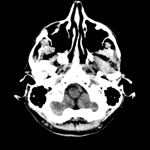 File:Artery of Percheron infarct (Radiopaedia 48088-52893 Axial non-contrast 3).jpg