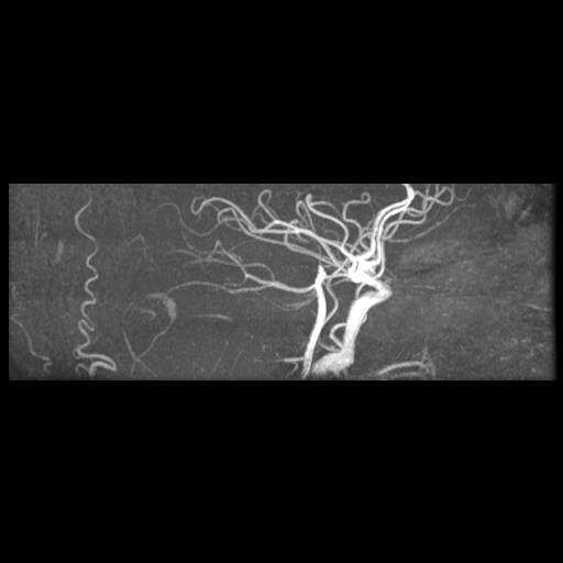 Artery of Percheron infarction (Radiopaedia 27975-28230 3D TOF 20).jpg