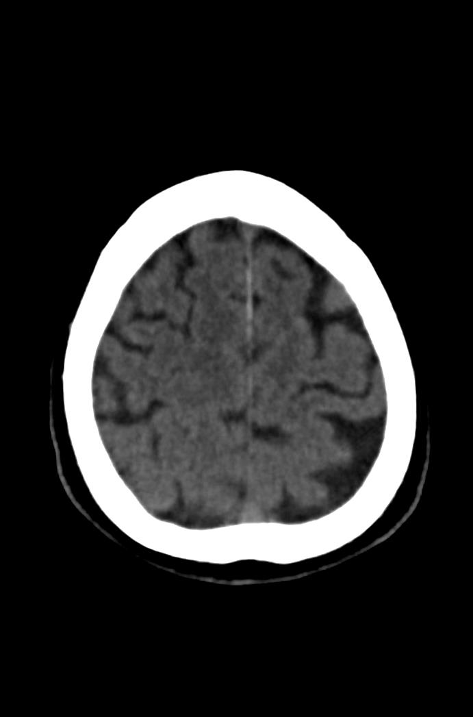 Artery of Percheron infarction (Radiopaedia 80613-94202 Axial non-contrast 157).jpg
