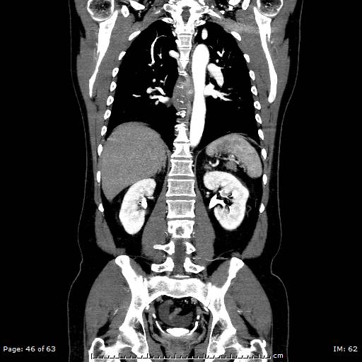 File:Ascending aortic aneurysm (Radiopaedia 50086-55404 B 46).jpg