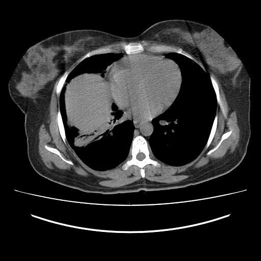 File:Ascending retrocecal appendicitis with liver abscesses (Radiopaedia 60066-67615 Axial non-contrast 1).jpg
