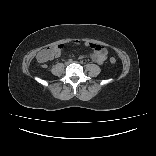 Ascending retrocecal appendicitis with liver abscesses (Radiopaedia 60066-67615 Axial non-contrast 55).jpg