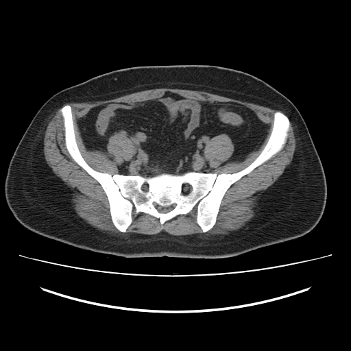 File:Ascending retrocecal appendicitis with liver abscesses (Radiopaedia 60066-67615 Axial non-contrast 65).jpg