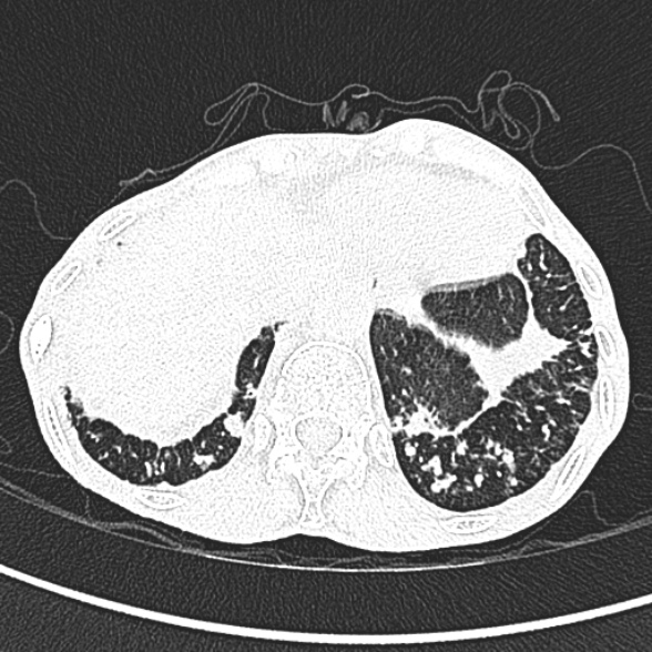 Aspergilloma- with Monod sign (Radiopaedia 44737-48532 Axial lung window 269).jpg
