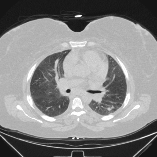 Aspergilloma (Radiopaedia 39611-41932 Axial lung window 59).jpg