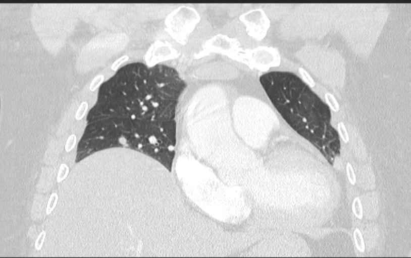 Aspirated tooth (Radiopaedia 28584-28844 Axial lung window 45).jpg