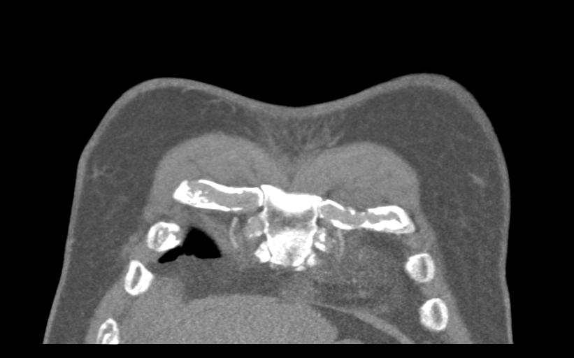 Aspirated tooth (Radiopaedia 28584-28844 Coronal C+ CTPA 8).jpg
