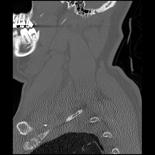 Atlanto-occipital dissociation injury (Radiopaedia 29274-29698 Sagittal bone window 8).png