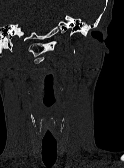 Atlantoaxial subluxation (Radiopaedia 44681-48450 Coronal bone window 1).jpg