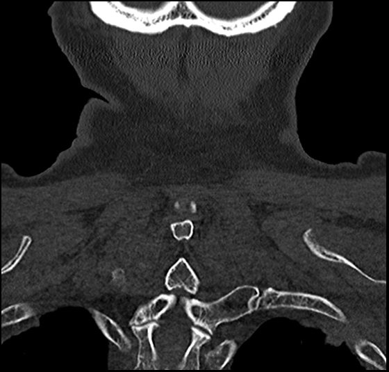 Atlas (type 3b subtype 1) and axis (Anderson and D'Alonzo type 3, Roy-Camille type 2) fractures (Radiopaedia 88043-104607 Coronal bone window 56).jpg