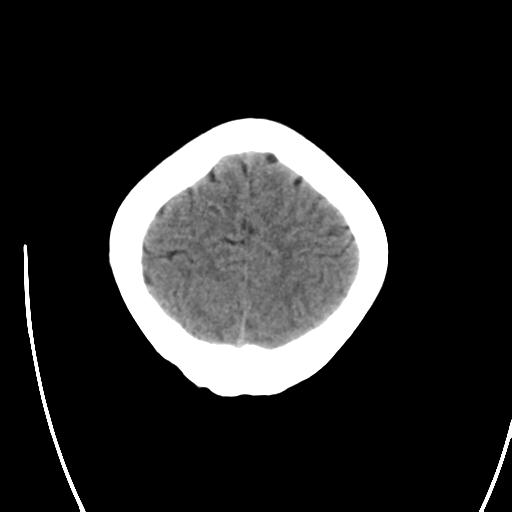File:Atretic encephalocoele with inferior vermis hypoplasia (Radiopaedia 30443-31107 A 23).jpg
