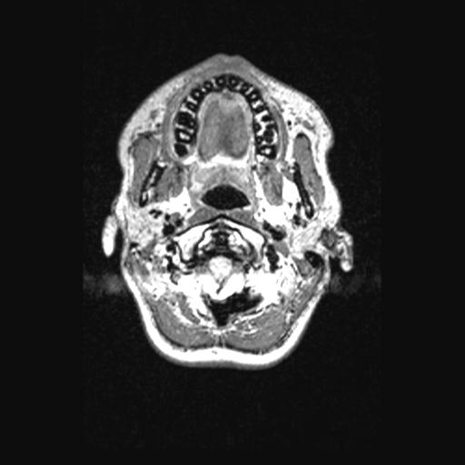 Atretic encephalocoele with inferior vermis hypoplasia (Radiopaedia 30443-31108 Axial 15).jpg