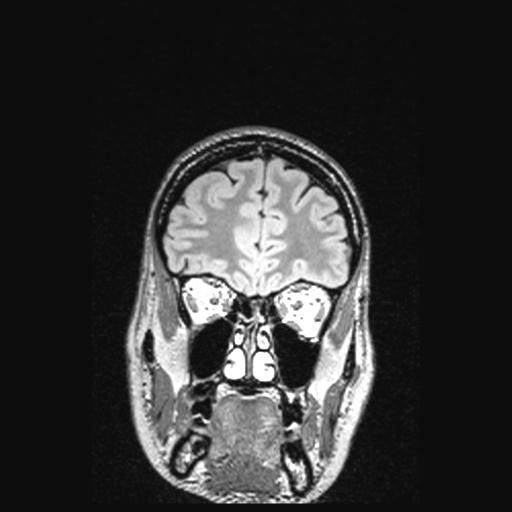 Atretic encephalocoele with inferior vermis hypoplasia (Radiopaedia 30443-31108 Coronal FLAIR 145).jpg