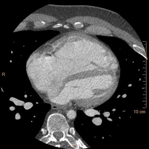 Atrial septal defect (upper sinus venosus type) with partial anomalous pulmonary venous return into superior vena cava (Radiopaedia 73228-83961 A 161).jpg