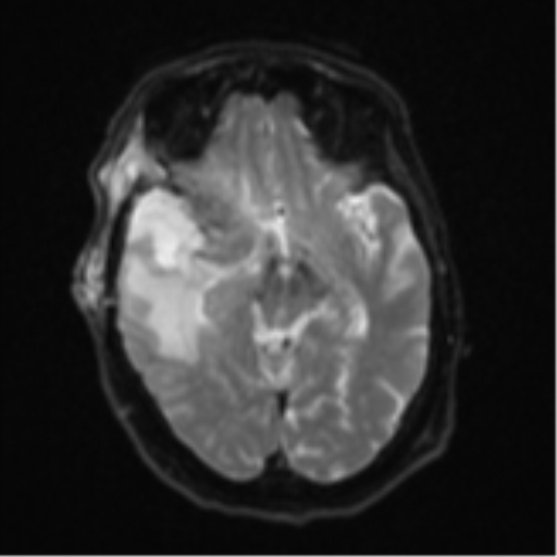 Atypical meningioma (WHO Grade II) (Radiopaedia 54742-60981 Axial DWI 12).png
