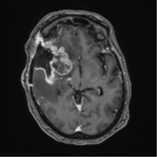 Atypical meningioma (WHO Grade II) (Radiopaedia 54742-60981 Axial T1 C+ 31).png