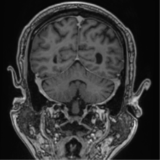 File:Atypical meningioma (WHO grade II) with brain invasion (Radiopaedia 57767-64729 Coronal T1 C+ 62).png