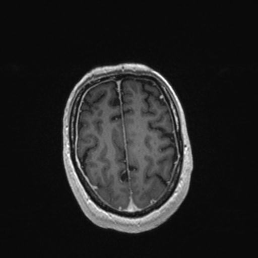 Atypical meningioma (grade II) - en plaque (Radiopaedia 29633-30147 Axial T1 C+ 147).jpg