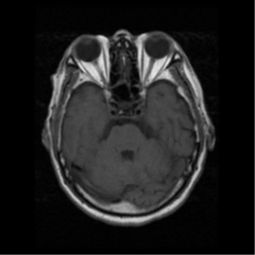 File:Atypical meningioma with skull invasion (Radiopaedia 34357-35648 Axial T1 7).png