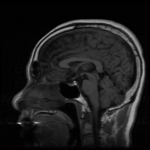File:Atypical meningioma with skull invasion (Radiopaedia 34357-35648 Sagittal T1 12).png
