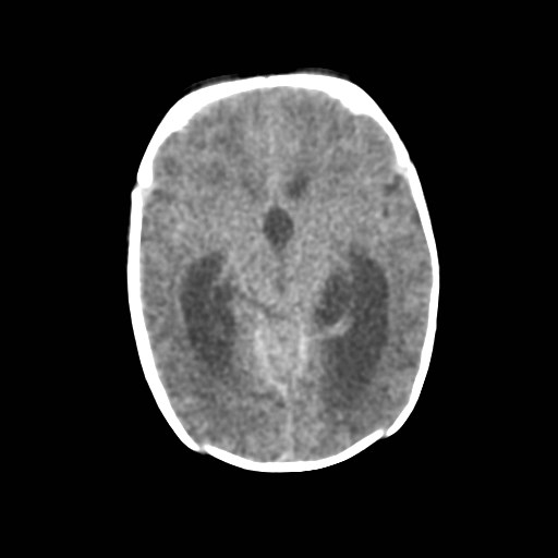 File:Atypical teratoid rhabdoid tumor (prenatal US and neonatal MRI) (Radiopaedia 59091-66387 Axial non-contrast 19).jpg