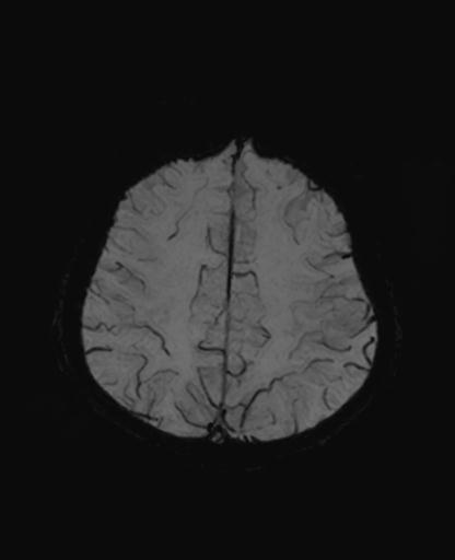 Autoimmune limbic encephalitis (Radiopaedia 30363-31005 SWI - mIP 55).jpg