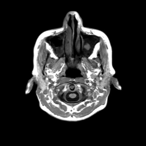 Autoimmune limbic encephalitis (Radiopaedia 30363-31005 T1 Axial 3mm 3).jpg