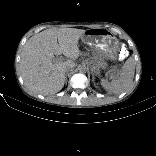 Autoimmune pancreatitis (Radiopaedia 84925-100431 Axial non-contrast 17).jpg
