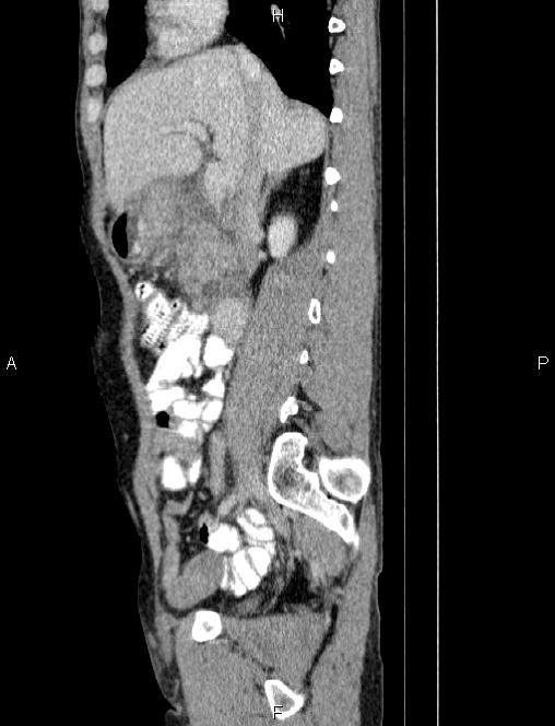 Autoimmune pancreatitis (Radiopaedia 84925-100431 E 36).jpg