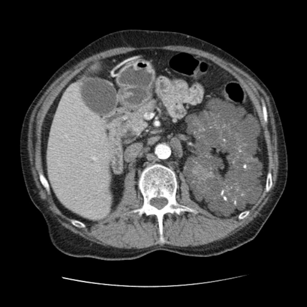 Autosomal dominant polycystic kidney disease (Radiopaedia 27851-28094 B 69).jpg