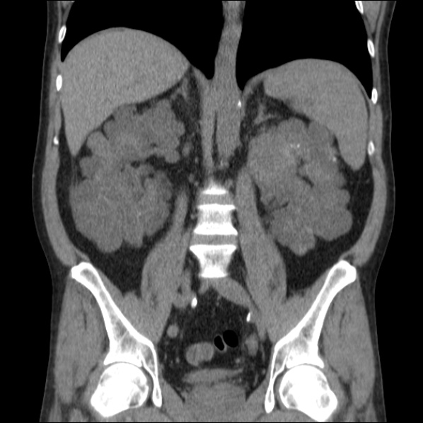 Autosomal dominant polycystic kidney disease (Radiopaedia 36539-38101 C 41).jpg