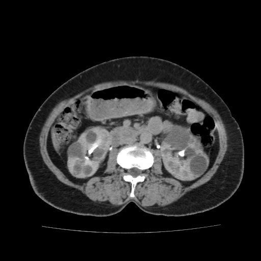 Autosomal dominant polycystic kidney disease (Radiopaedia 38189-40194 Axial C+ delayed 24).jpg