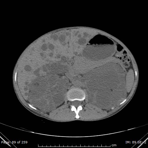 Autosomal dominant polycystic kidney disease (Radiopaedia 44122-47684 Axial non-contrast 32).jpg