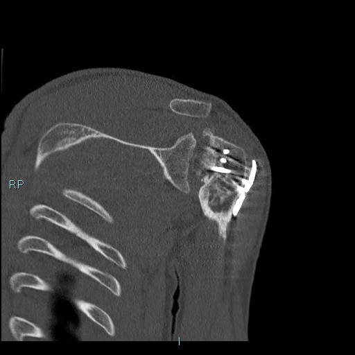 Avascular necrosis after fracture dislocations of the proximal humerus (Radiopaedia 88078-104655 Coronal bone window 82).jpg