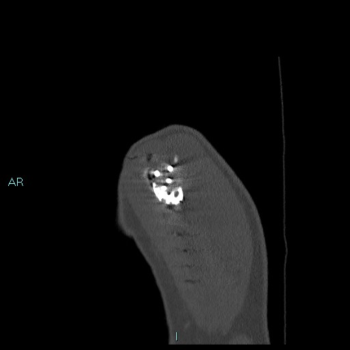 File:Avascular necrosis after fracture dislocations of the proximal humerus (Radiopaedia 88078-104655 Sagittal bone window 8).jpg