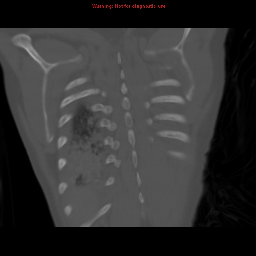 File:Avascular necrosis in sickle cell disease (Radiopaedia 17448-17152 Coronal bone window 111).jpg