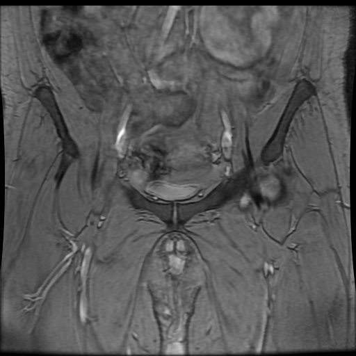 Avascular necrosis of the hip (Radiopaedia 61503-69465 F 18).jpg
