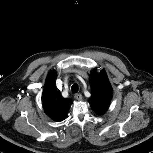 File:Azygos continuation of the inferior vena cava (Radiopaedia 18537-18404 C+ arterial phase 11).jpg