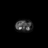 B-cell lymphoma of the mesentery (Radiopaedia 65743-74868 18F-FDG PET-CT 154).jpg
