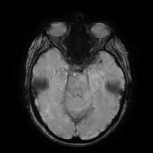 File:Balo concentric sclerosis (Radiopaedia 53875-59982 Axial 3D SWAN 32).jpg
